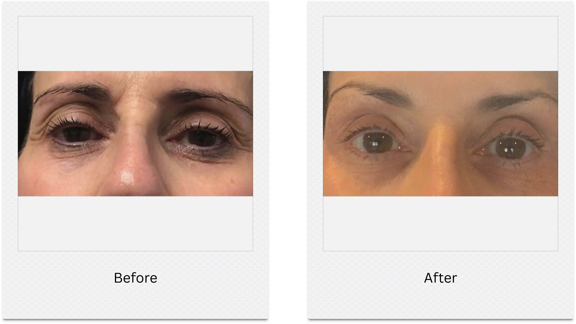 plasma eye lift full eye rejuvenation before after