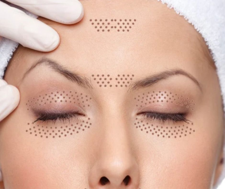 Plasma Eye Lift