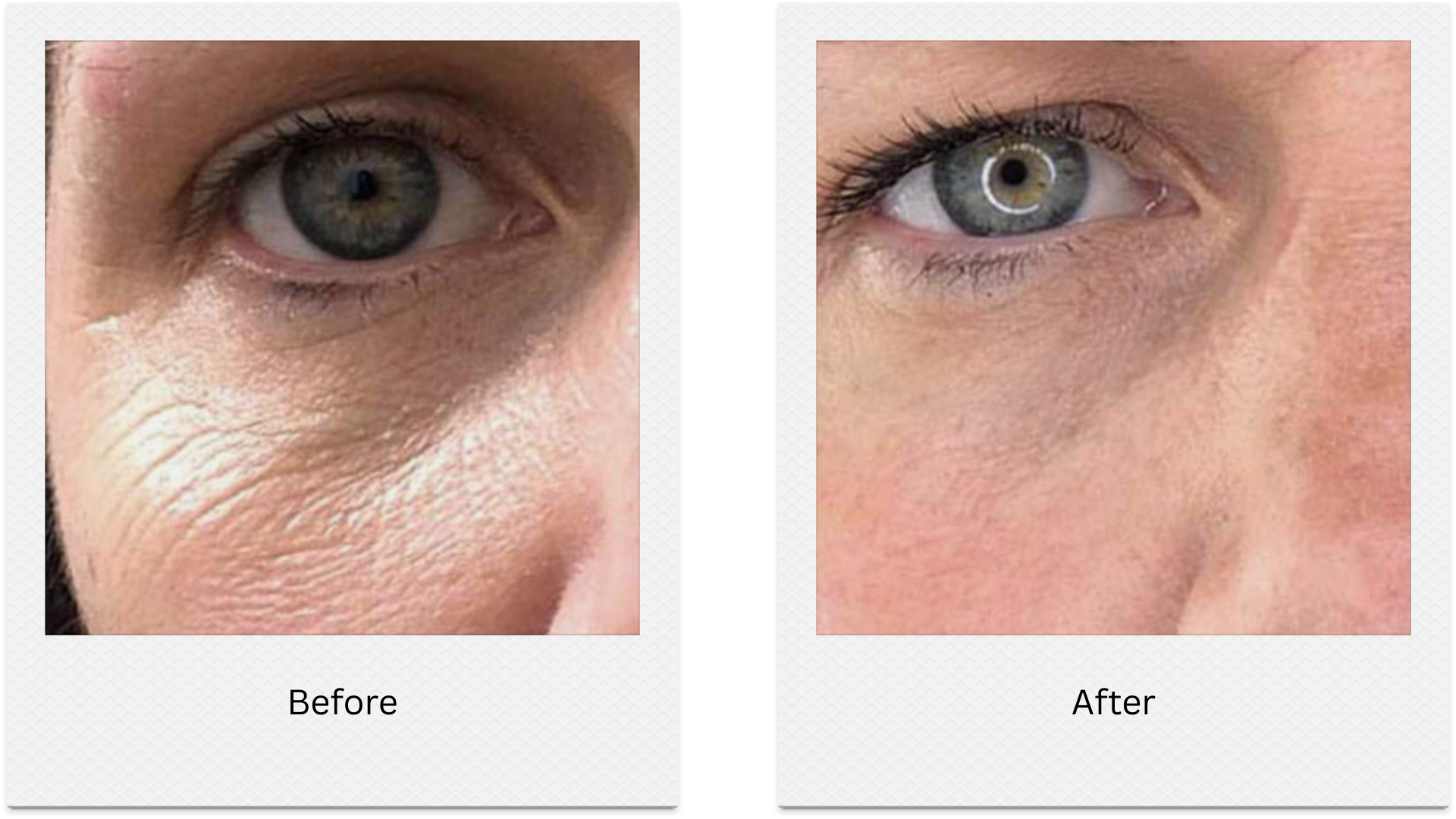 plasma eye lift under eye wrinkles before after