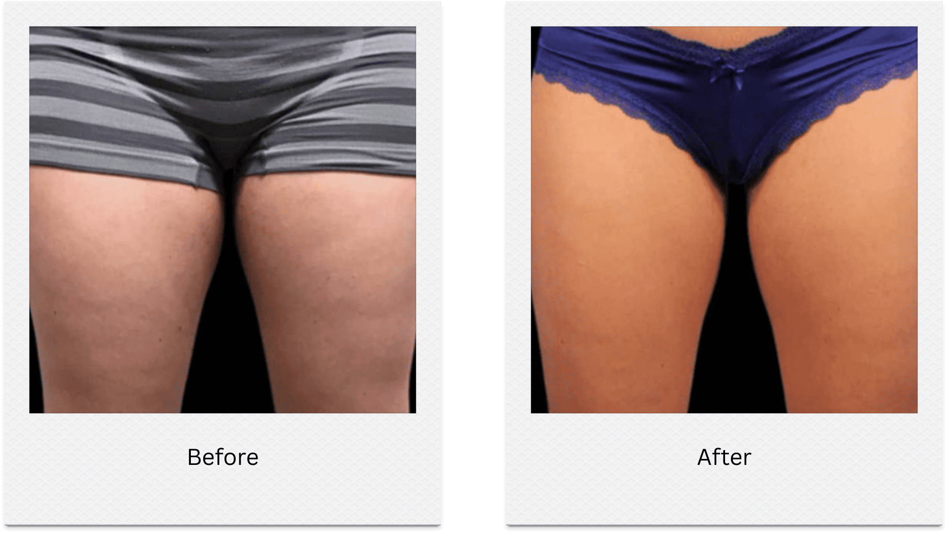 Thigh gap improvement after fat freezing treatment before after