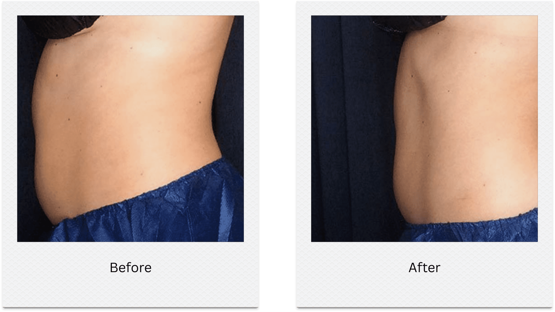 Waist side fat freezing before after contour improvement
