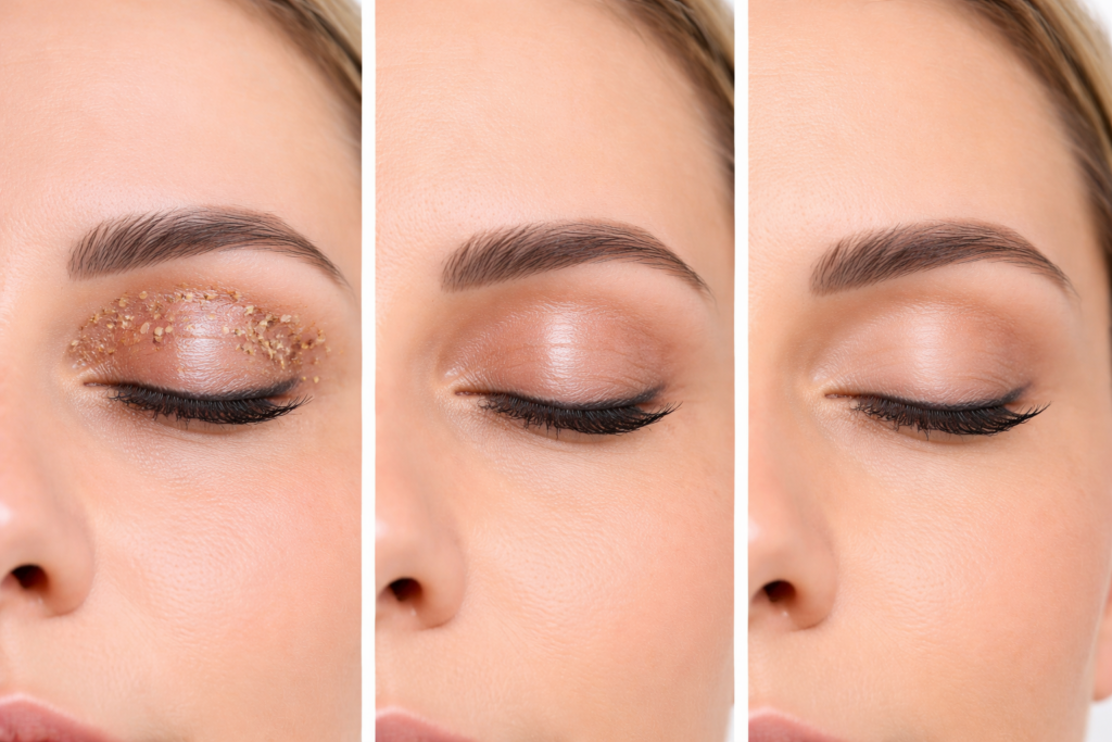 Plasma Eye Lift