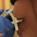 cryolipolysis for love handles