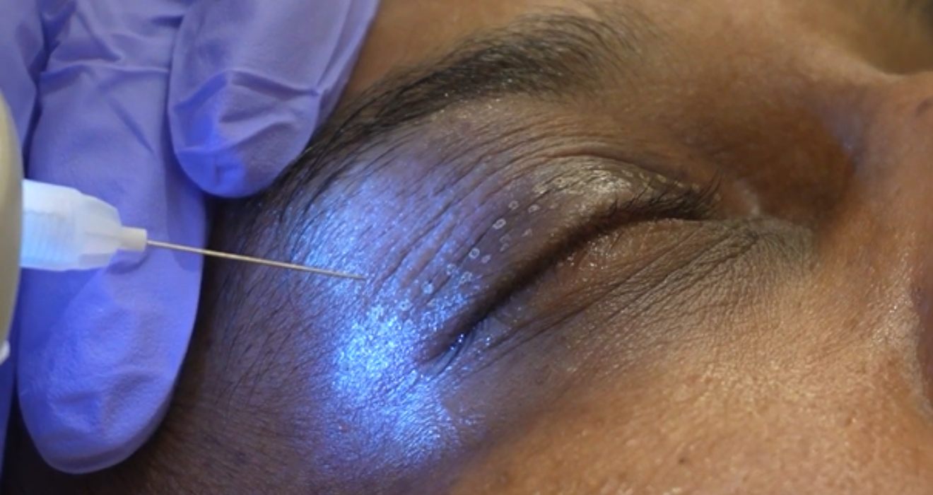 Plasma Eye Lift Healing Stages Day by Day | Full Recovery Guide