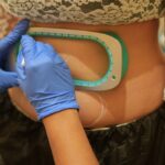 Cryolipolysis After Pregnancy