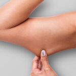 Cryolipolysis for Upper Arms