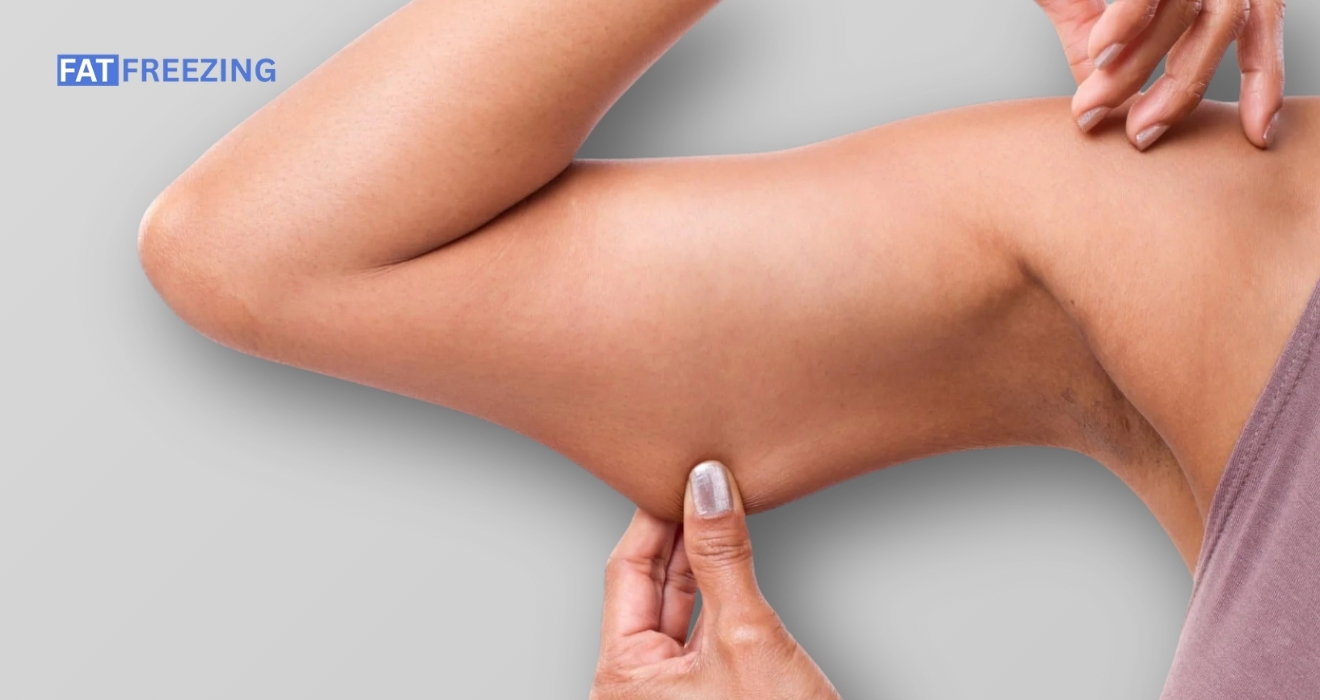 Cryolipolysis for Upper Arms