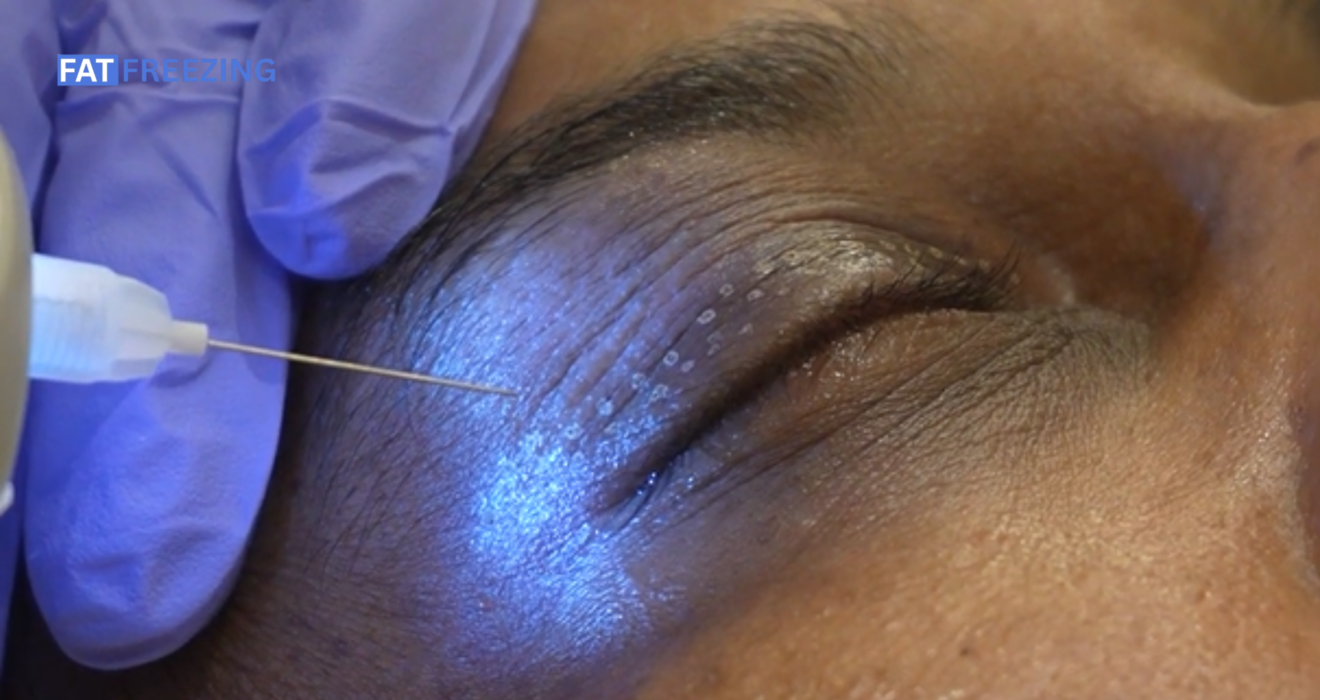 Plasma Eye Lift: Non-Surgical Help for Periorbital Wrinkles