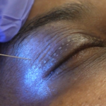 Plasma Eye Lift: Non-Surgical Help for Periorbital Wrinkles