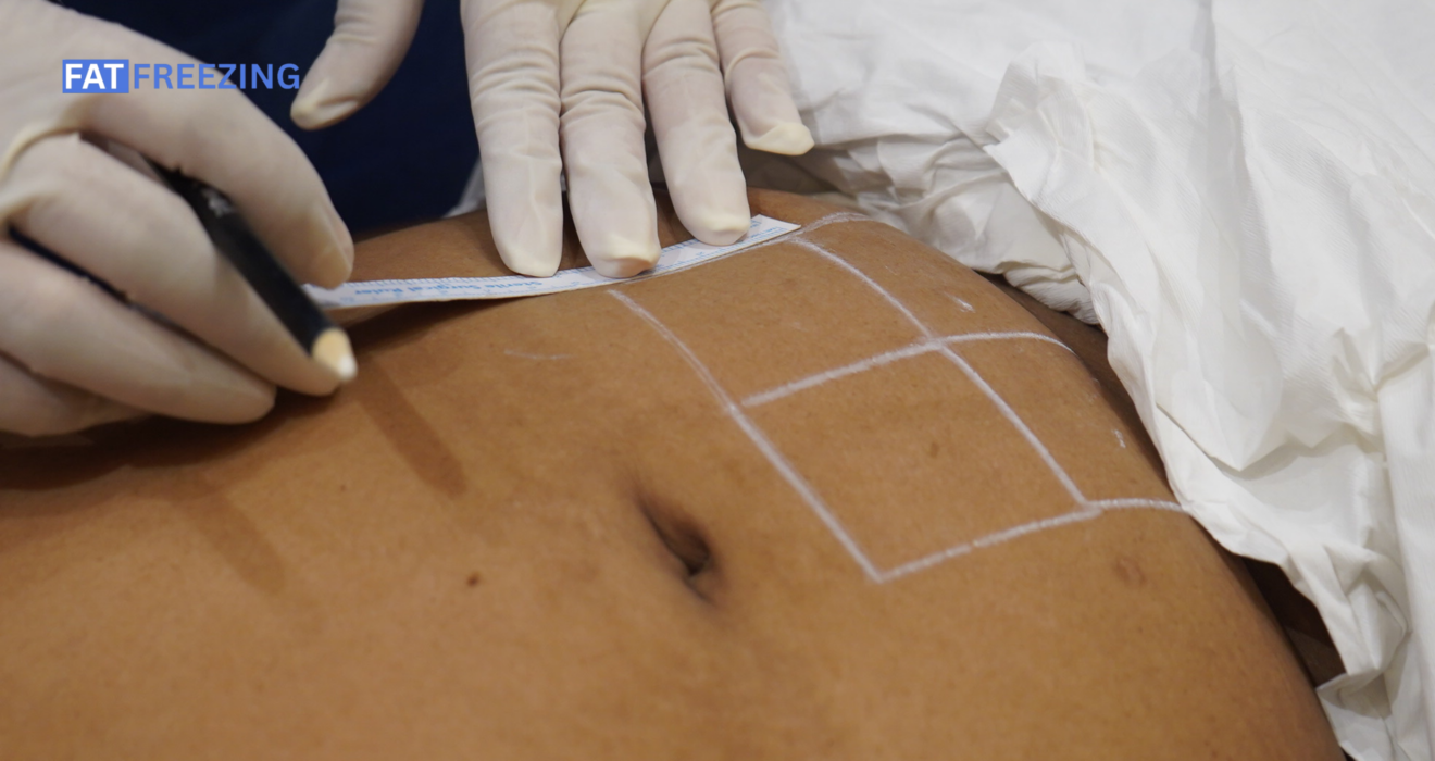 stubborn fat after weight loss