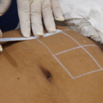 stubborn fat after weight loss
